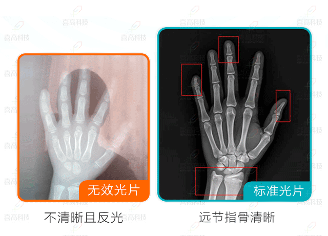 網(wǎng)上問診需要提供什么樣的骨齡片？.gif