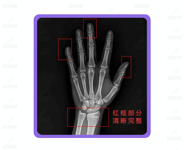 如何拍好手腕部X光片？怎樣做好防護？.gif